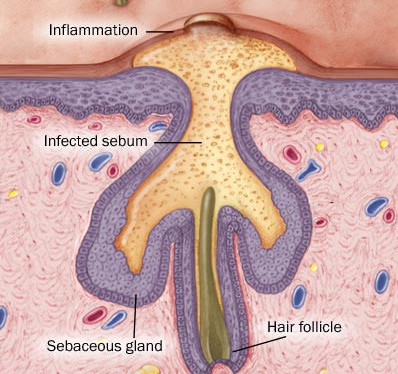 Schematic Acne